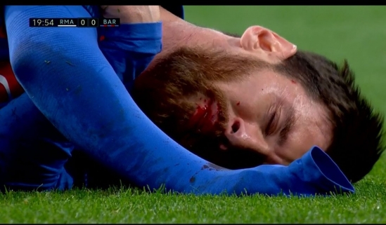 Hình ảnh Messi ngậm khăn cầm máu thi đấu trên sân gây sốt